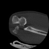 SPORK, NICO - 22.03.1976 - 02.08.2022 - CT obere Extremität - 17:51:17